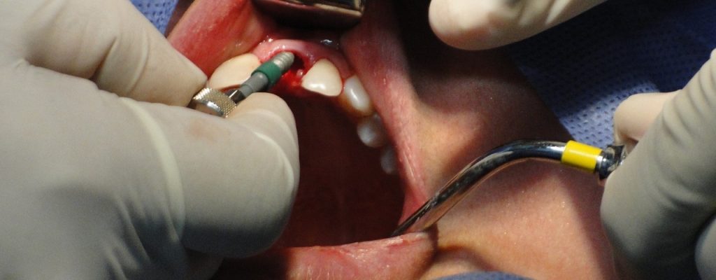foto implante dental
